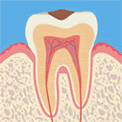 虫歯レベル1（C1）