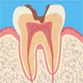 >虫歯レベル2（C2）
