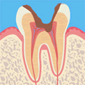 虫歯レベル3（C3）